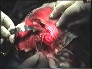 Rzayev R.M. Ossifying fibroma of the nasal cavity-Craniofacial resection.