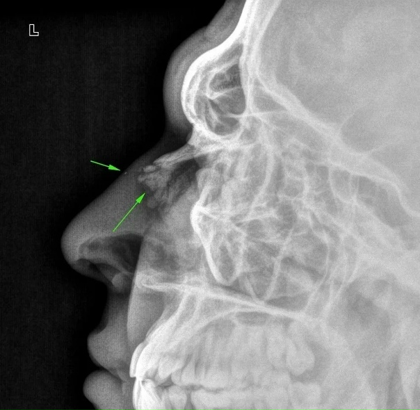 Ринопластика до и после