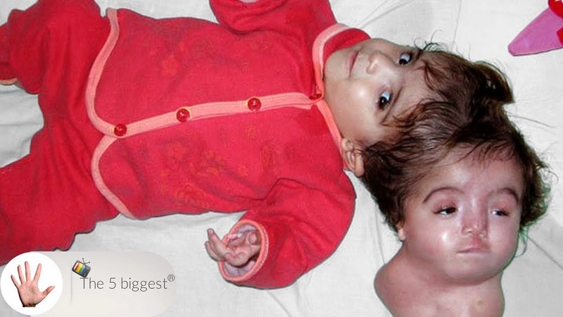 The Girl with the Living Head: Dying for you to live, , After separation pictures Body
